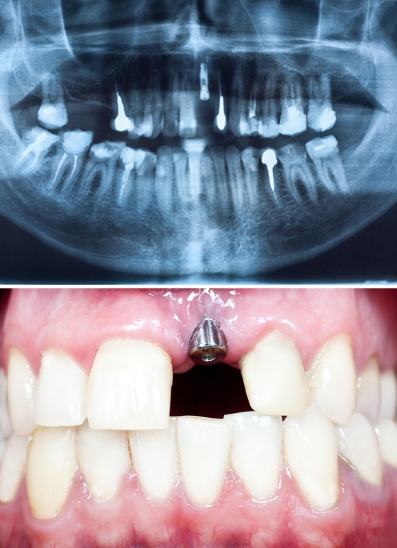 implant-in-oral-cavity
