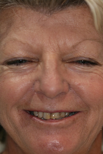 Full face view of a females smile before cosmetic dental work