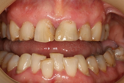 Closeup view of smile before a cosmetic dental procedure with Dr. Lee