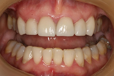 Closeup view of a smile after a cosmetic dental procedure