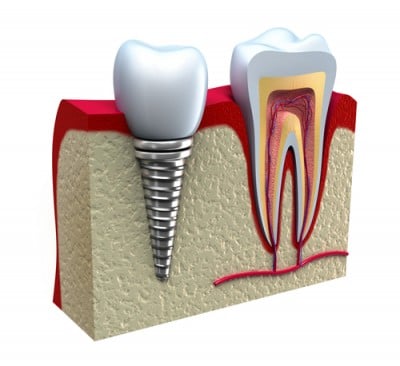 picture-of-dental-implants