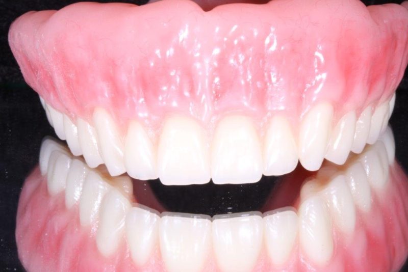 Is it time to replace your dentures?
