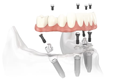 Dental implants diagram