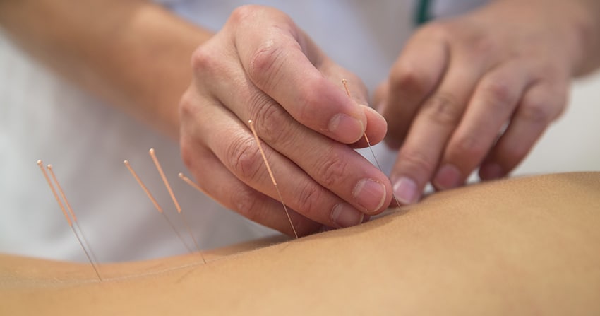 Treatment by acupuncture