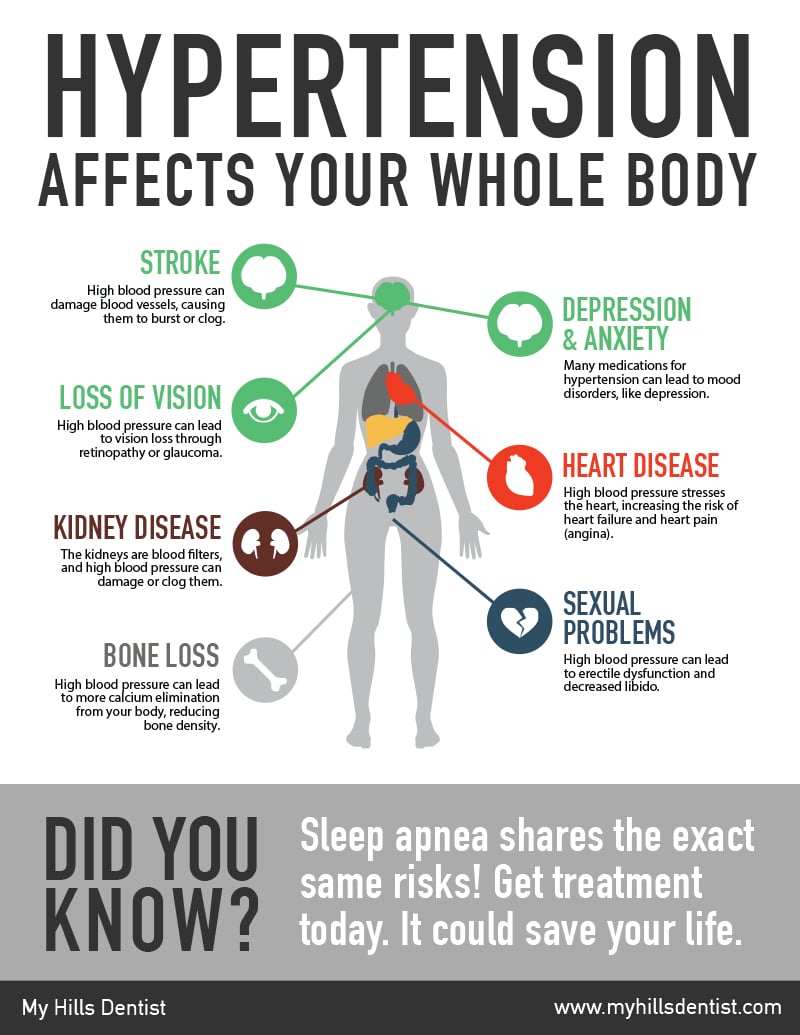 A infographic about the relationship between Hypertension and Sleep Apnea, get more information at My Hills Dentist in Sydney, Australia