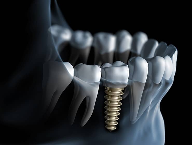 Implants Still an Option Years after Tooth Loss 