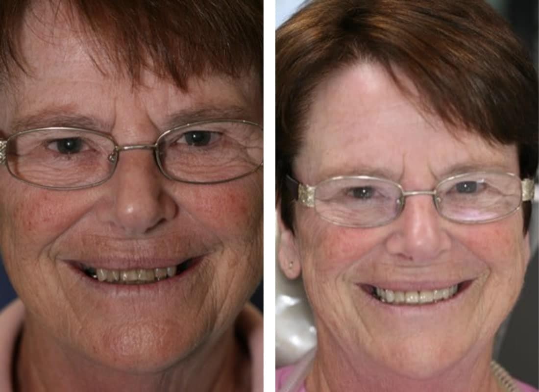 before and after dental implants female patient