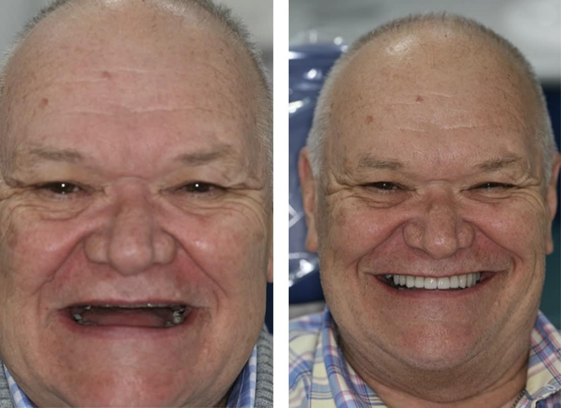 before and after dental implants male patient