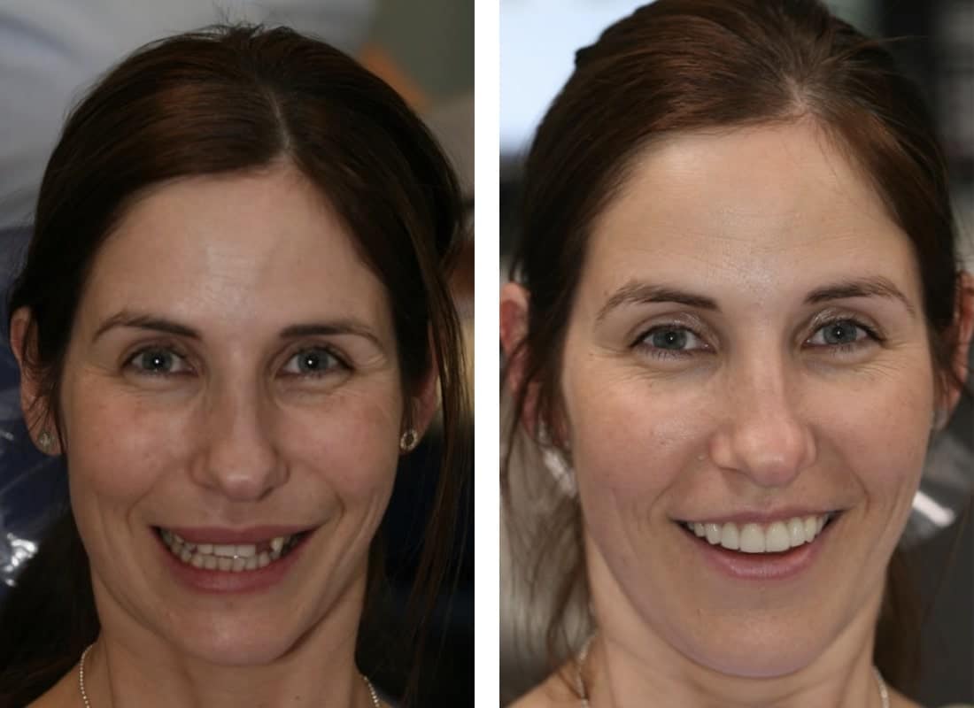 before and after dental implants female patient