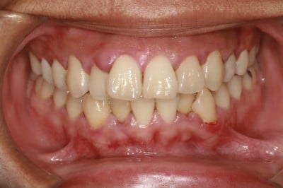 Sydney gum disease