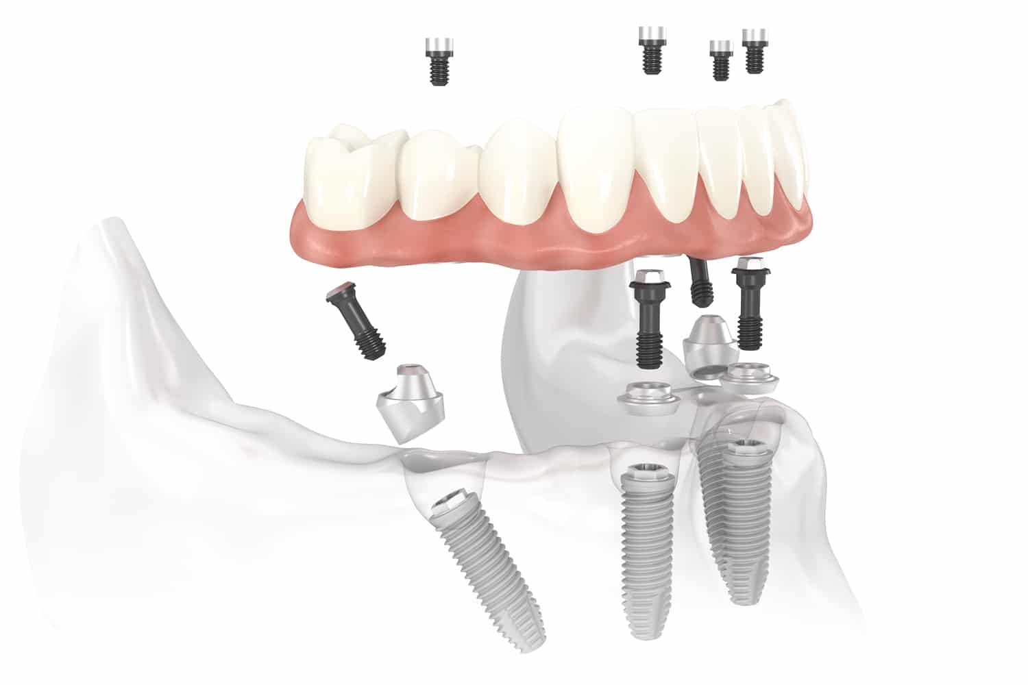 All on Four Implant Dentures Sydney