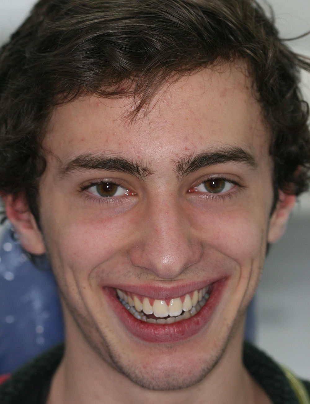 Closeup view of a smile after a cosmetic dental procedure