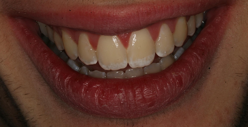 Closeup view of a smile after a cosmetic dental procedure