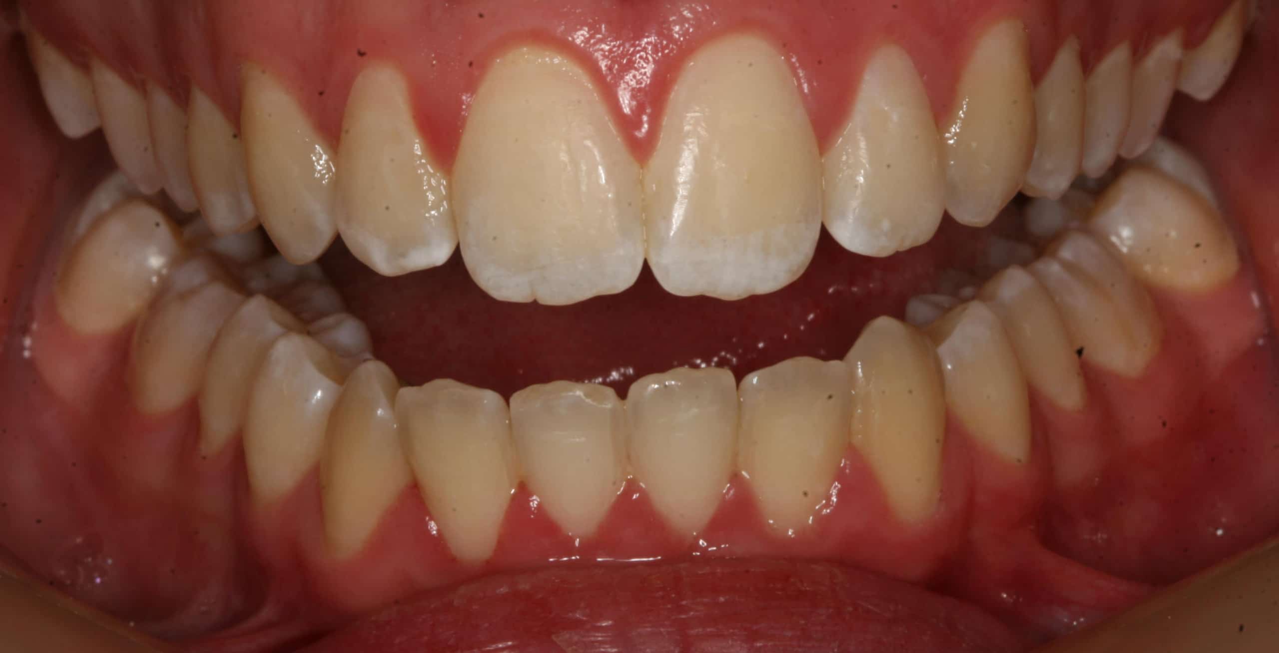 Closeup view of a smile before dental work