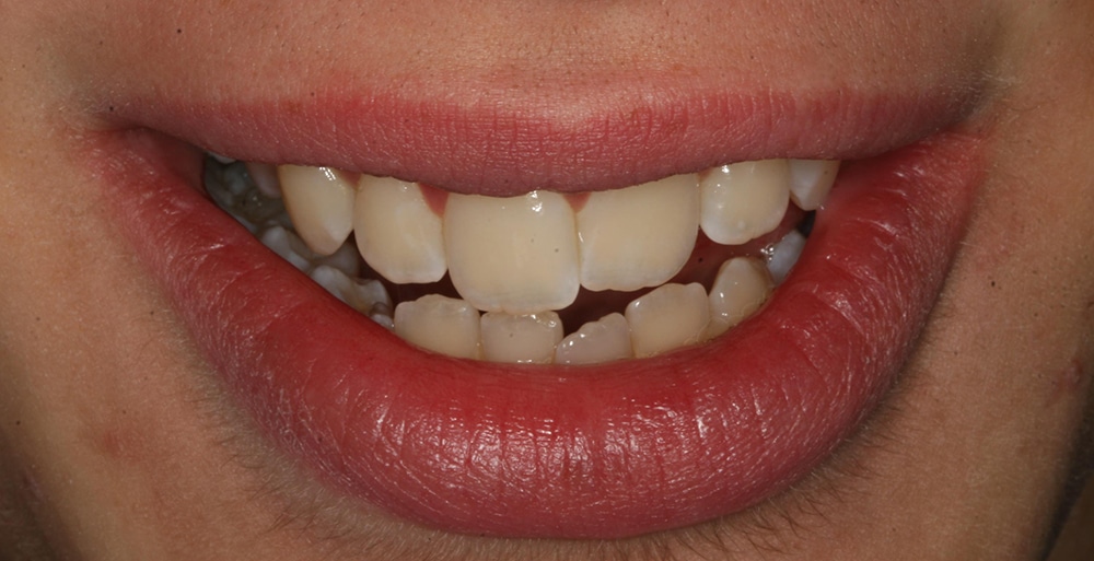 Closeup smile of a dental patient before completing work with Dr. Lee