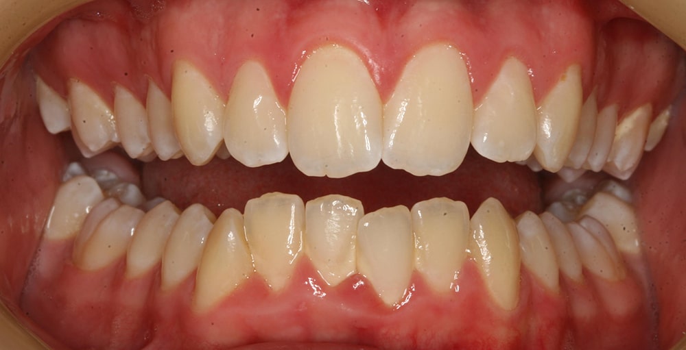 Closeup view of teeth before a dental treatment with Dr. Lee