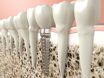 Illustration of dental implants rooted